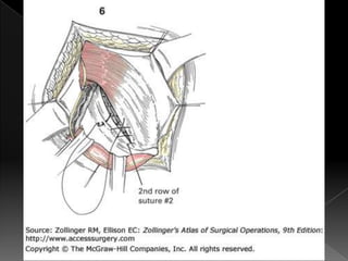 Hernia inguinal con tension