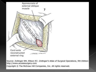 Hernia inguinal con tension