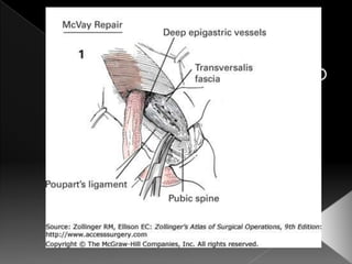 Hernia inguinal con tension