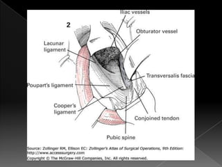 Hernia inguinal con tension