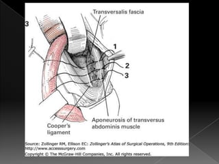 Hernia inguinal con tension
