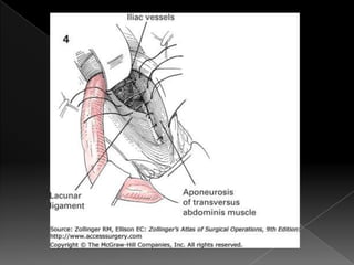 Hernia inguinal con tension