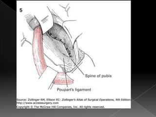 Hernia inguinal con tension