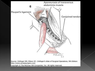 Hernia inguinal con tension
