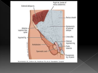 Hernia inguinal con tension
