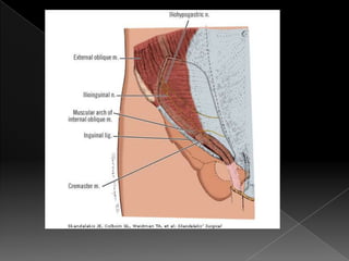 Hernia inguinal con tension
