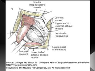 Hernia inguinal con tension