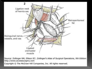 Hernia inguinal con tension