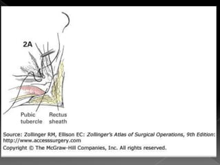 Hernia inguinal con tension