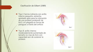Clasificación de Gilbert (1989)
 Tipo I: hernia indirecta con anillo
interno pequeño, estrecho,
apretado apto para la colocación
de una prótesis prolene® de
6x11 cm plegada en forma de
paraguas a través del orificio
 Tipo II: anillo interno
moderadamente aumentado de
tamaño no mas de 4cm con
capacidad aún de sostener la
protesis
 