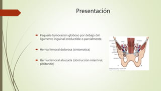Presentación
 Pequeña tumoración globoso por debajo del
ligamento inguinal irreductible o parcialmente.
 Hernia femoral dolorosa (sintomatica)
 Hernia femoral atascada (obstrucción intestinal,
peritonitis)
 