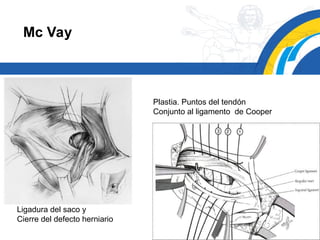 Mcvay Incision Hernia Inguinal final en cirugia general | PPT