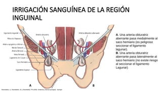 IRRIGACIÓN SANGUÍNEA DE LA REGIÓN
INGUINAL
A. Una arteria obturatriz
aberrante pasa medialmente al
saco hemiario (es peligroso
seccionar el ligamento
lagunar).
B. Una arteria obturatriz
aberrante pasa lateralmente al
saco hemiario (no existe riesgo
al seccionar el ligamento
Lagunar)
Skandalakis, LJ, Skandalakis, JE y Skandalakis, PN (2009). Anatomía y técnica quirúrgica . Springer.
 