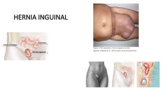 HERNIA INGUINAL
 