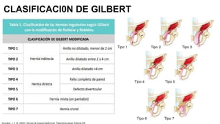 CLASIFICACI0N DE GILBERT
González, J. C. M. (2023). Hernias de la pared abdominal: Tratamiento actual. Editorial Alfil.
 