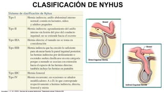 CLASIFICACIÓN DE NYHUS
González, J. C. M. (2023). Hernias de la pared abdominal: Tratamiento actual. Editorial Alfil.
 