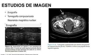 ESTUDIOS DE IMAGEN
• Ecografía
• Tomografía computarizada
Resonancia magnética nuclear
González, J. C. M. (2023). Hernias de la pared abdominal: Tratamiento actual. Editorial Alfil.
 