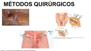 MÉTODOS QUIRÚRGICOS
González, J. C. M. (2023). Hernias de la pared abdominal: Tratamiento actual. Editorial Alfil.
 