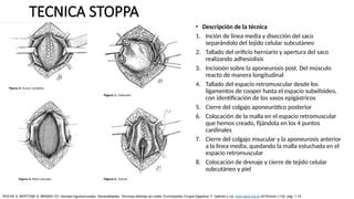 TECNICA STOPPA
• Descripción de la técnica
1. Inción de línea media y disección del saco
separándolo del tejido celular subcutáneo
2. Tallado del orificio herniario y apertura del saco
realizando adhesiolisis
3. Incisioón sobre la aponeurosis post. Del músculo
reacto de manera longitudinal
4. Tallado del espacio retromuscular desde los
ligamentos de cooper hasta el espacio subxifoideo,
con identificación de los vasos epigástricos
5. Cierre del colgajo aponeurótico posterior
6. Colocación de la malla en el espacio retromuscular
que hemos creado, fijándola en los 4 puntos
cardinales
7. Cierre del colgajo msucular y la aponeurosis anterior
a la línea media, quedando la malla estuchada en el
espacio retromuscular
8. Colocación de drenaje y cierre de tejido celular
subcutáneo y piel
ROCHE S, BERTONE S, BRANDI CD: Hernias inguinocrurales. Generalidades. Técnicas abiertas sin malla. Enciclopedia Cirugía Digestiva. F. Galindo y col. www.sacd.org.ar 2018;tomo I-132: pág. 1-15
 