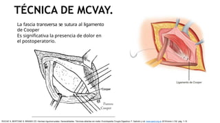 TÉCNICA DE MCVAY.
La fascia transversa se sutura al ligamento
de Cooper
Es significativa la presencia de dolor en
el postoperatorio.
ROCHE S, BERTONE S, BRANDI CD: Hernias inguinocrurales. Generalidades. Técnicas abiertas sin malla. Enciclopedia Cirugía Digestiva. F. Galindo y col. www.sacd.org.ar 2018;tomo I-132: pág. 1-15
 