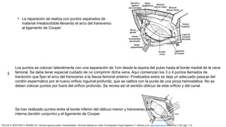 • La reparación se realiza con puntos separados de
material irreabsorbible llevando el arco del transverso
al ligamento de Cooper
Los puntos se colocan lateralmente con una separación de 1cm desde la espina del pubis hasta el borde medial de la vena
femoral. Se debe tener especial cuidado de no comprimir dicha vena. Aquí comienzan los 3 o 4 puntos llamados de
transición que fijan el arco del transverso a la fascia femoral anterior. Finalizados estos se deja un adecuado pasa-je del
cordón espermático por el nuevo orificio inguinal profundo, que se calibra con la punta de una pinza hemostática. No se
deben colocar puntos por fuera del orificio profundo. Se recrea así el sentido oblicuo de este orificio y del canal.
Se han realizado puntos entre el borde inferior del oblicuo menor y transverso parte
interna (tendón conjunto) y el ligamento de Cooper.
1
ROCHE S, BERTONE S, BRANDI CD: Hernias inguinocrurales. Generalidades. Técnicas abiertas sin malla. Enciclopedia Cirugía Digestiva. F. Galindo y col. www.sacd.org.ar 2018;tomo I-132: pág. 1-15
 