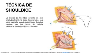 TÉCNICA DE
SHOULDICE
La técnica de Shouldice consiste en abrir
longitudinalmente la fascia transversalis, para
luego repararla, usando cuatro líneas de sutura
continua con dos hebras de material
idealmente irreabsorbible, monofilamento
ROCHE S, BERTONE S, BRANDI CD: Hernias inguinocrurales. Generalidades. Técnicas abiertas sin malla. Enciclopedia Cirugía Digestiva. F. Galindo y col. www.sacd.org.ar 2018;tomo I-132: pág. 1-15
 