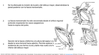 1 Se ha efectuado la incisión de la piel y del oblicuo mayor, observándose la
pared posterior con la fascia transversalis.
La fascia transversalis ha sido seccionada desde el orificio inguinal
profundo respetando los vasos epigástricos
hasta la espina del pubis.
2
3
Sección de la fascia cribiforme a la altura del septun crural
desde la vena femoral hacia adentro. Permite explorar la
existencia de una hernia crural y darle más vuelo a la hoja
inferior del oblicuo mayor
ROCHE S, BERTONE S, BRANDI CD: Hernias inguinocrurales. Generalidades. Técnicas abiertas sin malla. Enciclopedia Cirugía Digestiva. F. Galindo y col. www.sacd.org.ar 2018;tomo I-132: pág. 1-15
 