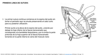 La primer sutura continua comienza en la espina del pubis sin
tomar el periostio aquí se anuda preservando el cabo corto
para su posterior utilización.
Primer punto a la altura de la espina del pubis, uniendo por
debajo la hoja inferior de la fascia transversalis que
corresponde a la bandeleta ileopubiana y por la arriba la parte
profunda de la hoja superior de la fascia transversalis
tomando en la parte interna la vaina del músculo recto
1
ROCHE S, BERTONE S, BRANDI CD: Hernias inguinocrurales. Generalidades. Técnicas abiertas sin malla. Enciclopedia Cirugía Digestiva. F. Galindo y col. www.sacd.org.ar 2018;tomo I-132: pág. 1-15
PRIMERA LINEA DE SUTURA
 