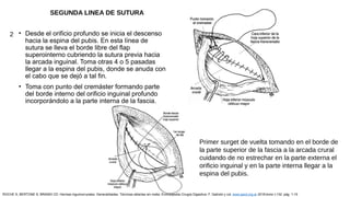 • Desde el orificio profundo se inicia el descenso
hacia la espina del pubis. En esta línea de
sutura se lleva el borde libre del flap
superointerno cubriendo la sutura previa hacia
la arcada inguinal. Toma otras 4 o 5 pasadas
llegar a la espina del pubis, donde se anuda con
el cabo que se dejó a tal fin.
• Toma con punto del cremáster formando parte
del borde interno del orificio inguinal profundo
incorporándolo a la parte interna de la fascia.
2
Primer surget de vuelta tomando en el borde de
la parte superior de la fascia a la arcada crural
cuidando de no estrechar en la parte externa el
orificio inguinal y en la parte interna llegar a la
espina del pubis.
SEGUNDA LINEA DE SUTURA
ROCHE S, BERTONE S, BRANDI CD: Hernias inguinocrurales. Generalidades. Técnicas abiertas sin malla. Enciclopedia Cirugía Digestiva. F. Galindo y col. www.sacd.org.ar 2018;tomo I-132: pág. 1-15
 