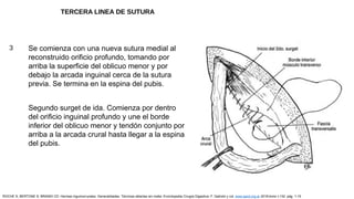 3 Se comienza con una nueva sutura medial al
reconstruido orificio profundo, tomando por
arriba la superficie del oblicuo menor y por
debajo la arcada inguinal cerca de la sutura
previa. Se termina en la espina del pubis.
Segundo surget de ida. Comienza por dentro
del orificio inguinal profundo y une el borde
inferior del oblicuo menor y tendón conjunto por
arriba a la arcada crural hasta llegar a la espina
del pubis.
ROCHE S, BERTONE S, BRANDI CD: Hernias inguinocrurales. Generalidades. Técnicas abiertas sin malla. Enciclopedia Cirugía Digestiva. F. Galindo y col. www.sacd.org.ar 2018;tomo I-132: pág. 1-15
TERCERA LINEA DE SUTURA
 