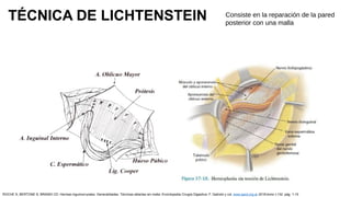 TÉCNICA DE LICHTENSTEIN Consiste en la reparación de la pared
posterior con una malla
ROCHE S, BERTONE S, BRANDI CD: Hernias inguinocrurales. Generalidades. Técnicas abiertas sin malla. Enciclopedia Cirugía Digestiva. F. Galindo y col. www.sacd.org.ar 2018;tomo I-132: pág. 1-15
 