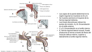 • Las capas de la pared abdominal en la
región inguinal se muestran en B y D.
• Se muestra asimismo el trayecto de la
hernia inguinal indirecta.
• Las líneas discontinuas indican los
puntos de incisión. A y B, Encarcelación
en el anillo externo.
• C y D, Encarcelación en el anillo interno.
• E, Hernia inguinal lateral inusual. Puede
producirse la hernia a través de fibras del
músculo oblicuo interno, superior y
lateralmente al anillo inguinal interno.
Skandalakis, LJ, Skandalakis, JE y Skandalakis, PN (2009). Anatomía y técnica quirúrgica . Springer.
 