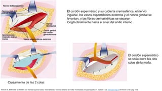 El cordón espermático y su cubierta cremastérica, el nervio
inguinal, los vasos espermáticos externos y el nervio genital se
levantan, y las fibras cremastéricas se separan
longitudinalmente hasta el nivel del anillo interno.
Cruzamiento de las 2 colas
El cordón espermático
se sitúa entre las dos
colas de la malla.
ROCHE S, BERTONE S, BRANDI CD: Hernias inguinocrurales. Generalidades. Técnicas abiertas sin malla. Enciclopedia Cirugía Digestiva. F. Galindo y col. www.sacd.org.ar 2018;tomo I-132: pág. 1-15
 