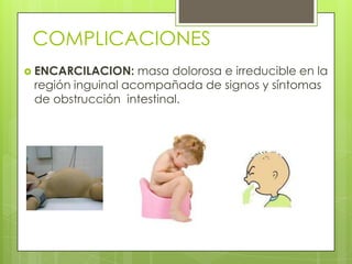 COMPLICACIONES
 ENCARCILACION:   masa dolorosa e irreducible en la
 región inguinal acompañada de signos y síntomas
 de obstrucción intestinal.
 