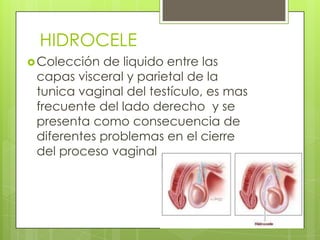 HIDROCELE
 Colección de liquido entre las
 capas visceral y parietal de la
 tunica vaginal del testículo, es mas
 frecuente del lado derecho y se
 presenta como consecuencia de
 diferentes problemas en el cierre
 del proceso vaginal
 