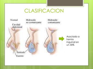 CLASIFICACION



                Asociado a
                hernia
                inguinal en
                un 30%
 
