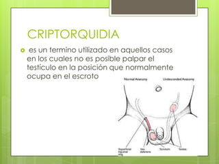 CRIPTORQUIDIA
    es un termino utilizado en aquellos casos
    en los cuales no es posible palpar el
    testículo en la posición que normalmente
    ocupa en el escroto
 