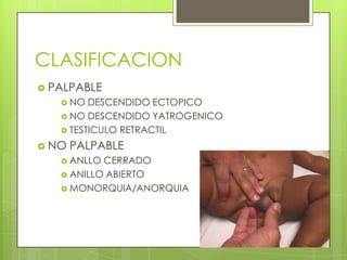 CLASIFICACION
 PALPABLE
    NO  DESCENDIDO ECTOPICO
    NO DESCENDIDO YATROGENICO
    TESTICULO RETRACTIL

 NO   PALPABLE
    ANLLO CERRADO
    ANILLO ABIERTO
    MONORQUIA/ANORQUIA
 