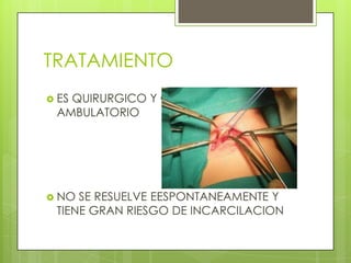 TRATAMIENTO
 ES
   QUIRURGICO Y GENERALMENTE
 AMBULATORIO




 NO SE RESUELVE EESPONTANEAMENTE Y
 TIENE GRAN RIESGO DE INCARCILACION
 
