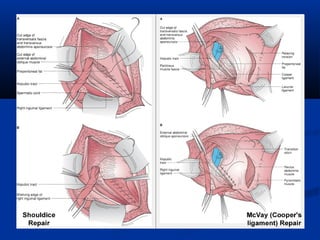 Mcvay Incision Hernia inguinalis | PPT