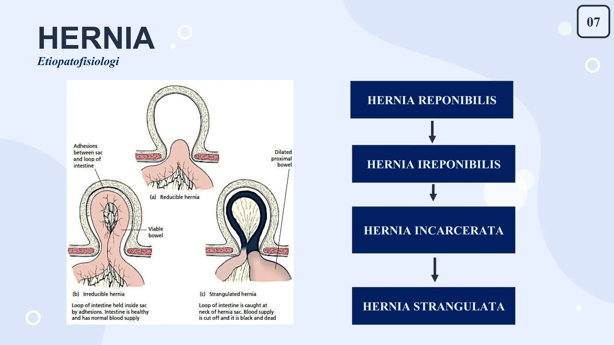Hernia Inguinalis dan Hidrokel pada Anak | PPTX