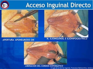 Embriología




                                  N. ILIOINGUINAL E ILIOHIPOGASTRICO
APERTURA APONEUROSIS OM




                LIBERACION DEL CORDON ESPERMATICO
                                      Cirugia de la hernia inguinal, Francesco Battocchino, Amolca
 
