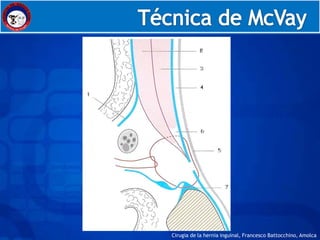 Embriología




Cirugia de la hernia inguinal, Francesco Battocchino, Amolca
 