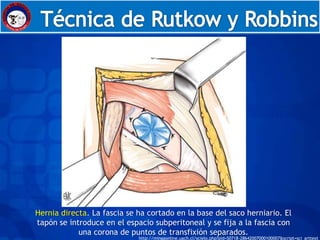 Embriología




Hernia directa. La fascia se ha cortado en la base del saco herniario. El
tapón se introduce en el espacio subperitoneal y se fija a la fascia con
            una corona de puntos de transfixión separados.
                             http://mingaonline.uach.cl/scielo.php?pid=S0718-28642007000100007&script=sci_arttext
 