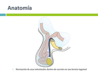 Anatomía
 Herniación de asas intestinales dentro de escroto en una hernia inguinal
 