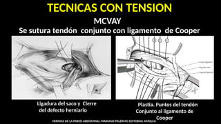 Mcvay Incision HERNIA INGUINAL TECNICA.pptx................................. | PPTX