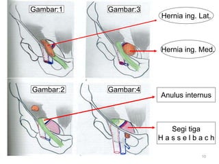 10
Hernia ing. Lat.
Hernia ing. Med.
Anulus internus
Segi tiga
H a s s e l b a c h
Gambar:1 Gambar:3
Gambar:2 Gambar:4
 