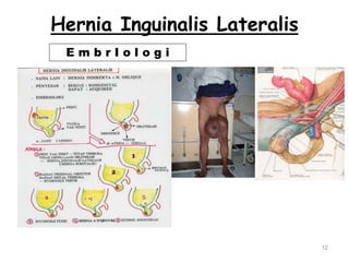 Hernia Inguinalis Lateralis
12
E m b r I o l o g i
 