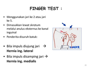 FINGER TEST :
• Menggunakan jari ke 2 atau jari
ke 5.
• Dimasukkan lewat skrotum
melalui anulus eksternus ke kanal
inguinal
• Penderita disuruh batuk:
• Bila impuls diujung jari 
Hernia ing. lateral
• Bila impuls disamping jari 
Hernia ing. medialis
20
 
