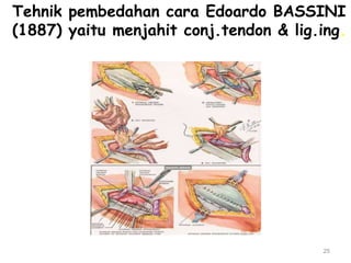 Tehnik pembedahan cara Edoardo BASSINI
(1887) yaitu menjahit conj.tendon & lig.ing.
25
 
